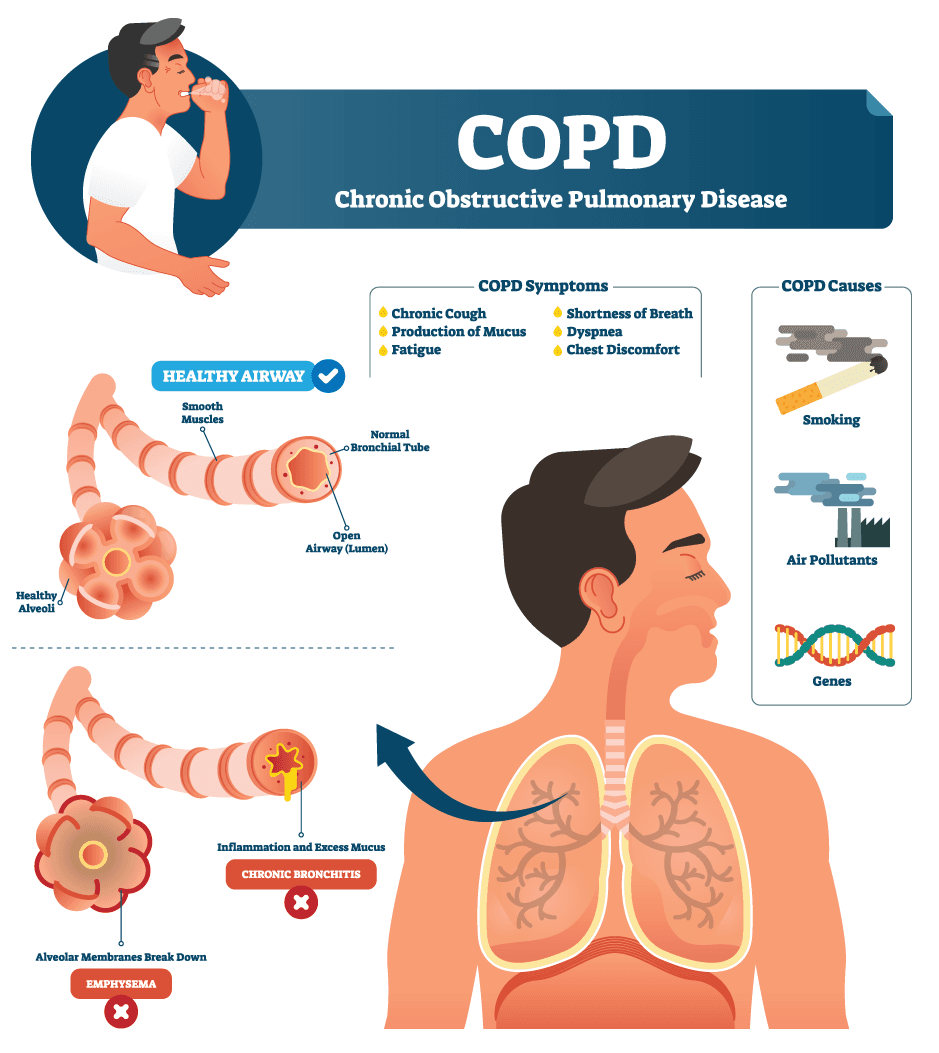 Copd Info 